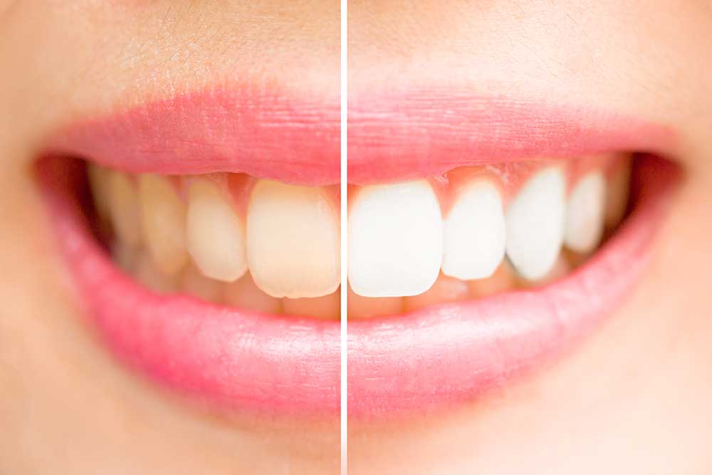Ästhetische Zahnheilkunde - Schöne Zähne ermuntern zum Lächeln
