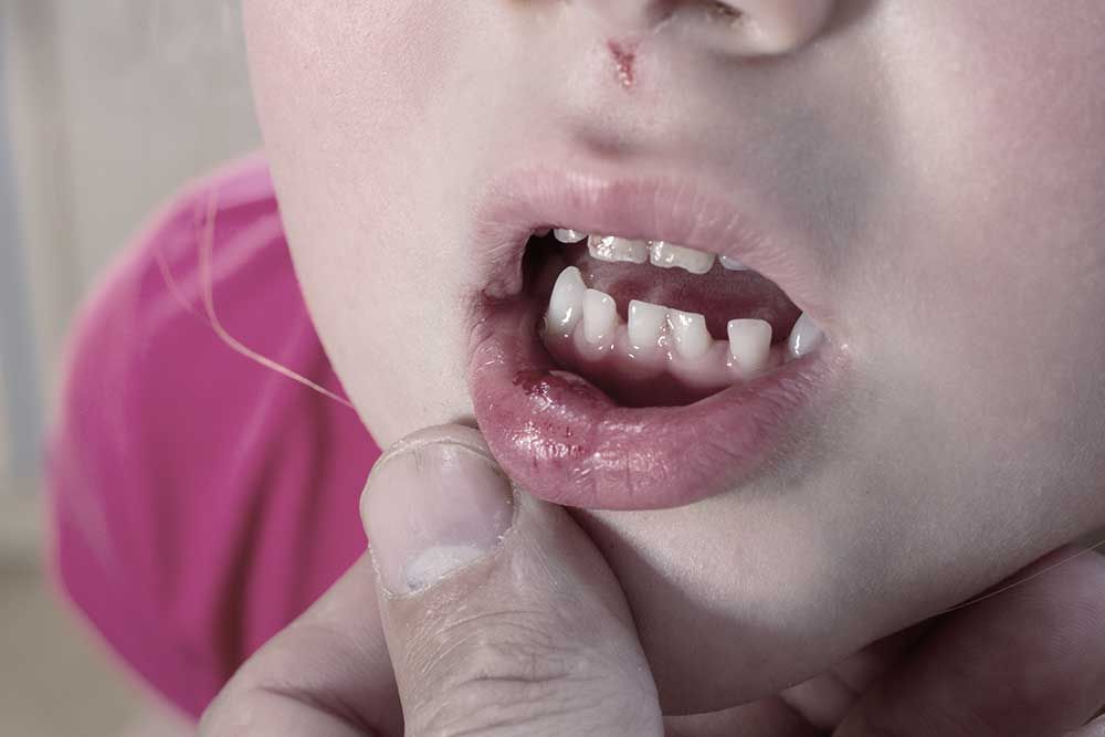Zahnunfall Traumalogie - Zahnunfall heisst nicht gleich Zahnverlust
