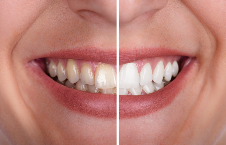 Strahlende Zähne dank unseres schonenden und zugleich effektiven Zahnbleachings.