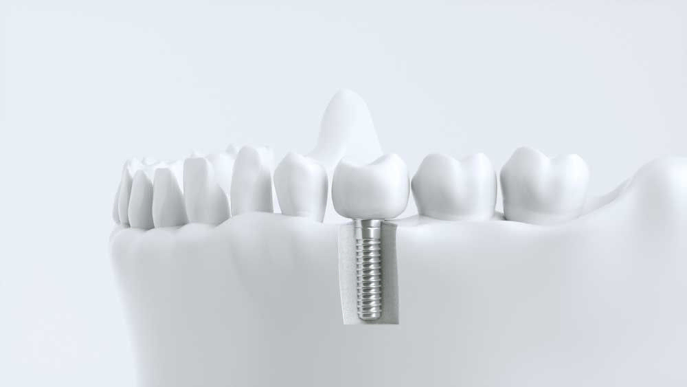 Zahnimplantate – Zahnersatz in Karlsruhe auf höchstem Niveau. 